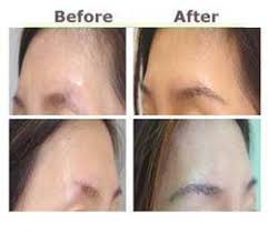 Hair Transplant Fut Strip Hair Transplant Technique Service Provider From Pune fut strip hair transplant technique