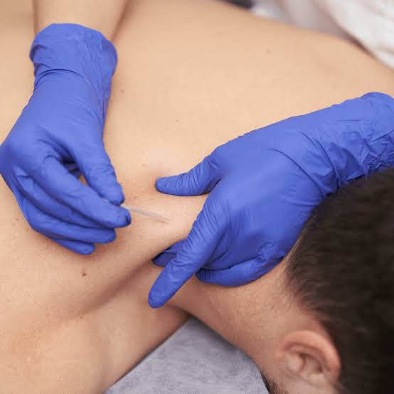 Dry Needling | Restore Function Physiotherapy
