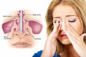 How To Cure Sinus Without Any Surgery