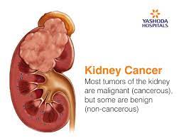 Kidney cancer is highly treatable when it's caught early, but patients often don't realize they have the symptoms of this serious cancer until it's too late. Tumors In Kidney Kidney Cancer Causes Symptoms Diagnosis And Treatment
