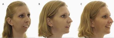 Image result for Micrognathia