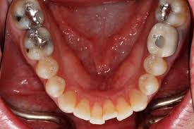 Image result for Occlusal