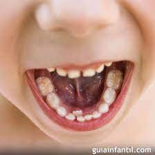 Por Que Hay Ninos Con Una Segunda Fila De Dientes