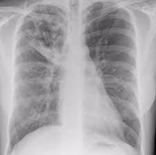 Dnp select income fd inc: Pulmonary Tuberculosis And Ppd Infectious Dis Medbullets Step 2 3