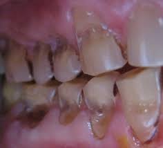 Image result for Tooth Abrasion