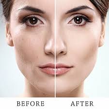 peach fuzz laser hair removal