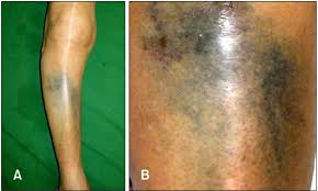 Image result for Pigment stains on the shin