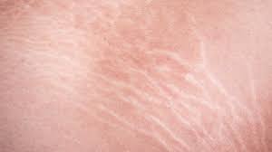 Exercise (particularly weightlifting) can boost the blood flow in the shoulder area, which stimulates faster cell turnover. 6 Ways To Get Rid Of White Stretch Marks