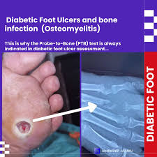 Image result for Probe-to-Bone Test