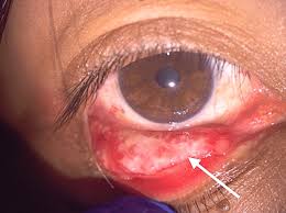 Parinaud's Syndrome-Causes-Diagnosis-Treatment Options-Dr-Qaisar-Ahmed