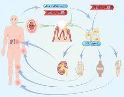 Image result for Hyperuricemia