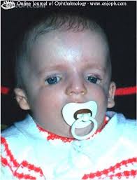 Franceschetti syndrome synonyms, franceschetti syndrome pronunciation, franceschetti syndrome translation, english dictionary definition of franceschetti syndrome. Atlas Of Ophthalmology