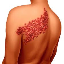 Wie sich eine gürtelrose ankündigt, welche komplikationen auftreten können und ob sie ansteckend ist. Gurtelrose Alternative Behandlung Mikroimmuntherapie