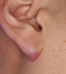 This is called the stage. When Cancer Can Mimic An Earlobe Pimple Know The Signs Scary Symptoms