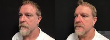 Neurotoxin Before and After Photo Gallery