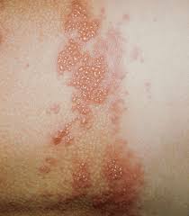 We'll explain how herpes simplex is transmitted, symptoms, and treatment options. Genital Herpes Hsv 1 2 Symptoms And Treatments