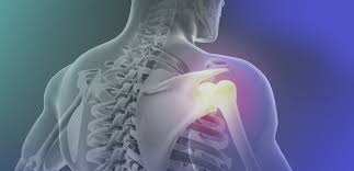 Bursite Subacromial (Ombro) - Ortho Clinic