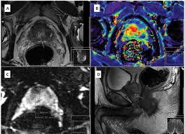 An ultrasound technique for killing cancer tumors without har. Repeat Transrectal Ultrasound Biopsies With Additional Targeted Cores According To Results Of Functional Prostate Mri Detects High Risk Prostate Cancer In Patients With Previous Negative Biopsy And Increased Psa A Pilot Study