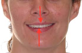 It may lead to crowding, when there is not enough space in your mouth, which results in. Orthodontics And Facial Beauty Part Iv Mid Line Discrepancy Austin Orthodontic Arts