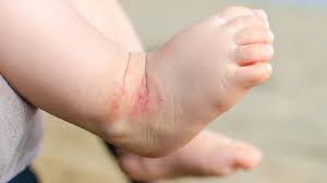 Bath Additives For Child Eczema Ineffective Study Finds Bbc News