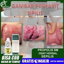 Raja singa atau sifilis adalah infeksi menular seksual yang disebabkan oleh bakteri treponema pallidum. Jual Obat Sepilis Spilis Sipilis Raja Singa Kencing Nanah Propolis Sm Kota Surabaya Latansashoop Tokopedia