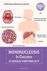 It is often difficult to prevent since many. Mono Kissing Disease Epstein Barr