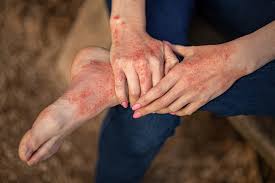 Image result for dermatitis contacta toxica