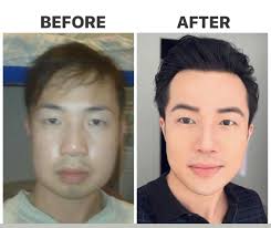 This Is Me After 10 Years Of Procedures Plasticsurgery