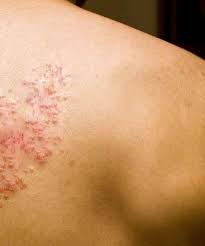 How To Get Rid Of Shingles Naturally Body Health Health And Beauty Tips Health Matters