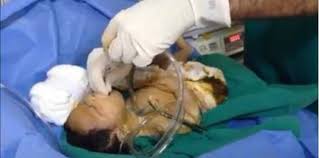 Demikian juga bila kandung kemih ibu tertekan oleh rahim yang. Aspirasi Mekonium Sindrom Bayi Meninggal Keracunan Air Ketuban Theasianparent Indonesia