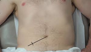 Image result for Shifting Dullness Test