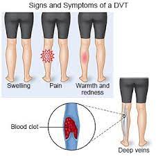 Deep Vein Thrombosis What You Need To Know