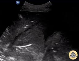 Image result for Air Bronchogram