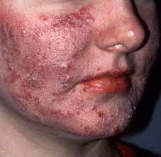 Weitere ideen zu rosazea, rosacea pflege. Hauterkrankung Rosazea Lasst Die Haut Im Gesicht Erbluhen Welt
