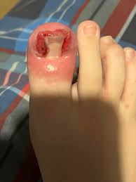 My sons toe, third time : rawfuleverything