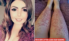 Laser hair removal makes the skin more sensitive and susceptible to sun damage. Woman S Body Reacted With Huge Hot Hives After Laser Hair Removal Procedure Daily Mail Online