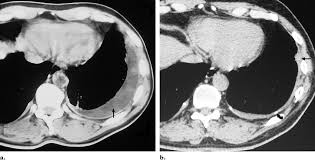 Almost always involve parietal … A Axial Ct Scan Of An Asbestos Exposed Person Shows A Left Sided Download Scientific Diagram