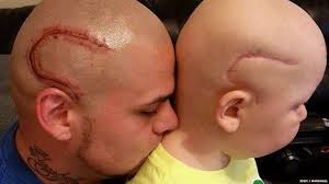 Tattoos can cause cancer and mutations — and one color is potentially more toxic than others, according to scientists.. Kansas Dad Gets A Tattoo To Match His Son S Brain Cancer Surgery Scar Bbc News