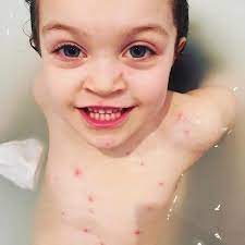 Unii copii au febra, dureri abdominale, sau chiar o senzatie usoara de greata in timpul eruptiei. Varicela Forma Usoara Bebe Strumf