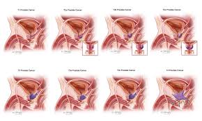 However, as with other types of cancer,. Prostate Cancer Symptoms Diagnosis Treatment Urology Care Foundation