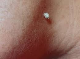 Image result for verrucae filiformes