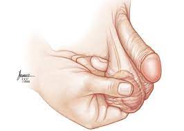 Cancer De Testiculo Y Autoexamen