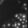 Cystická fibróza {multiststem inflammatory syndrome, covid19} reference. Category Cystic Fibrosis Wikimedia Commons