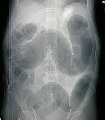 Initial common symptoms in patients presenting with colon cancer are abdominal pain, change in bowel habits, melaena, and general weakness  5 . An Unusual Case Of A Strangulated Right Inguinal Hernia Containing The Sigmoid Colon Sciencedirect