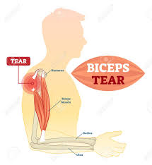 The anterior deltoid, the lateral deltoid, and the posterior deltoid. Biceps Tear Vector Illustration Labeled Medical Scheme With Royalty Free Cliparts Vectors And Stock Illustration Image 112249091