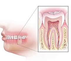 Root canal treatment involves the cleansing of root canal system with dental files and disinfectant agent. Root Canal Treatment India Root Canal Surgery Cost Procedure Dr Bhalla Dental Clinic
