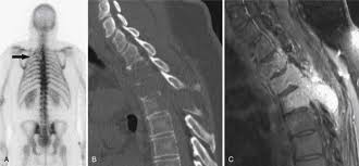 Transitional cell carcinoma of bladder 3. Bone Metastases Radiology Key