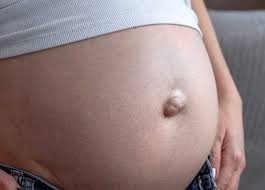 Die operative behandlung einer nabelhernie kann bei einem kleinen nabelbruch in lokalanästhesie erfolgen. Bauchnabelbruch Symptome Operation Gefahren Mit Bildern Und Video