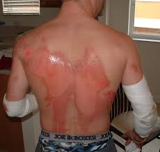 Massive Road Rash From No Motorcycle Jacket And Pants Crash Report Motorcycle Gear Hub