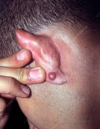 Image result for Keloid